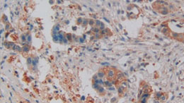 NGAL(Neutrophilgelatinase-Associated Lipocalin), a Marker of Nephropathy of Immunological Detection