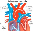 Cardiac Hypertrophy (CH)