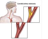 Carotid Atherosclerotic Stenosis (CAS)