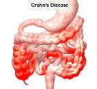 Crohn's Disease (CD)