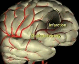 Embolic Cerebral Infarction (ECI)