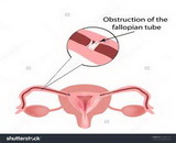 Fallopian Tube Obstruction (FTP)