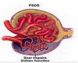 Glomerular Sclerosis (GS)