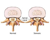 Lumbar Spinal  Stenosis (LSS)