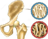 Osteoporosis (OP)
