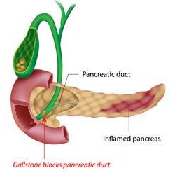 Acute Pancreatitis (AP)