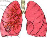 Pulmonary Fibrosis (PF)