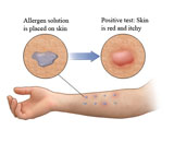 Skin Allergy (SA)