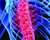 Actue Spinal Cord Injury (ASCI)