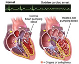 Sudden Cardiac Arrest (SCA)
