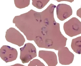 Plasmodium Falciparum (PF)