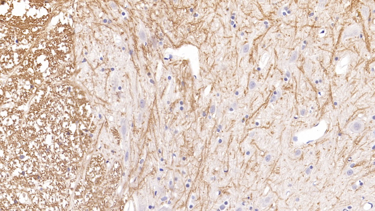 Monoclonal Antibody to Parathyroid Hormone Related Protein (PTHrP)