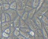 Transitional Cell Carcinoma Cells (TCC)