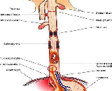 Esophagitis