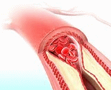 Hypercholesterolemia (HC)