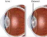 Cataract