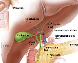 Cholecystitis