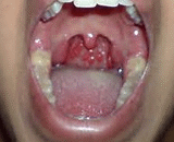 Chronic Pharyngitis (CP)