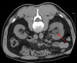 Hydronephrosis (HN)