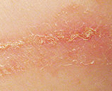 Contact Dermatitis (CD)