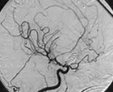 Delayed Cerebral Vasospasm (DCV)