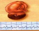 Fetal Distress (FD)