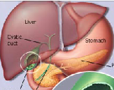 Gallstone (GS)