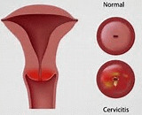 Cervicitis