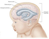 Hydrocephalus (HC)