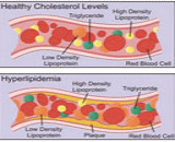 Hyperlipidemia (HL)