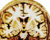 White Matter Injury (WMI)