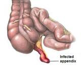 Appendicitis