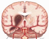 Intracerebral Hematoma (IH)