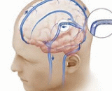 Intracranial Hypertension (IH)