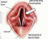 Laryngeal Paralysis (LP)