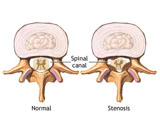 Lumbar Spinal Stenosis (LSS)