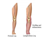 Lymphatic Edema (LE)