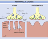 Myasthenia Gravis (MG)