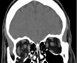 Orbital Fractures with Enophthalmos (PFE)