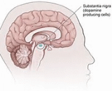 Parkinson's Disease (PD)