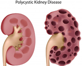 Polycystic Kidney Disease (PKD)