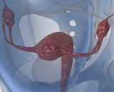 Premature Ovarian Failure (POF)