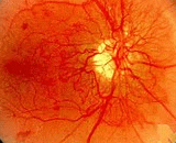 Retinal Neovascularization (RN)