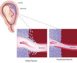 Preeclampsia (PE)