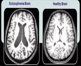 Schizophrenia (SZ)