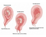 Spontaneous Abortion (SA)