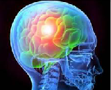 Traumatic Brain Injury (TBI)