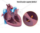 Ventricular Septal Defect (VSD)