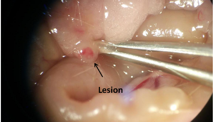 Mouse Model for Endometriosis (EM)