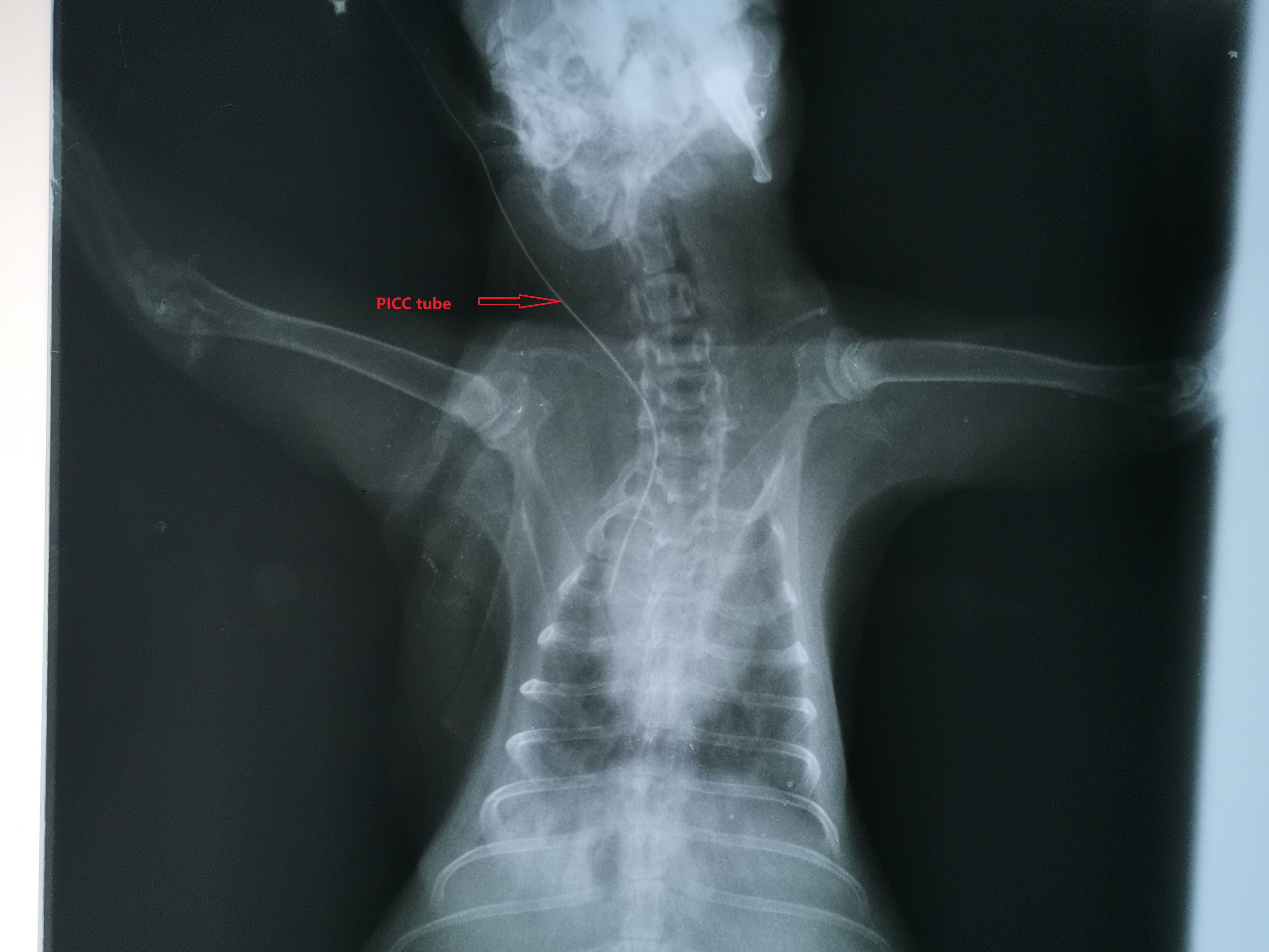 PICC tube inserted into anterior cardiac vena cava from ear margin vein